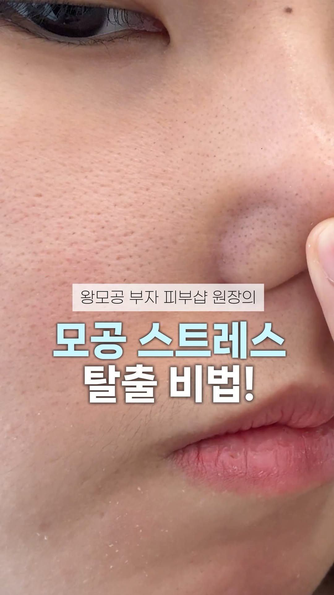 let_mein_ljh 게시물 이미지: 왕모공 탈출 비법📚

어릴때부터 왕모공으로 
친구가 얼굴에 왜 구멍이 있냐는...