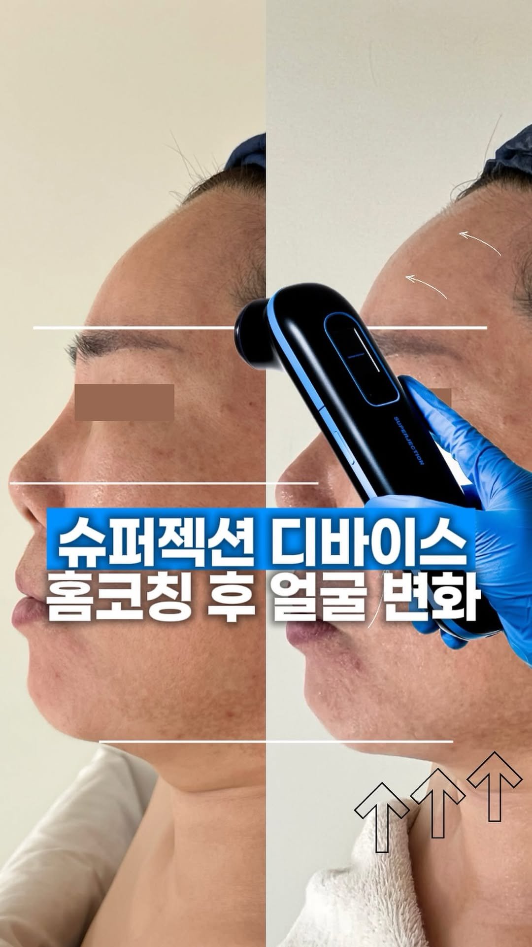 let_mein_ljh 게시물 이미지: 슈퍼젝션 디바이스 효과 엿보기☺️✨

한번씩 받아보시더니 효과가 너무 좋다며
써보신...