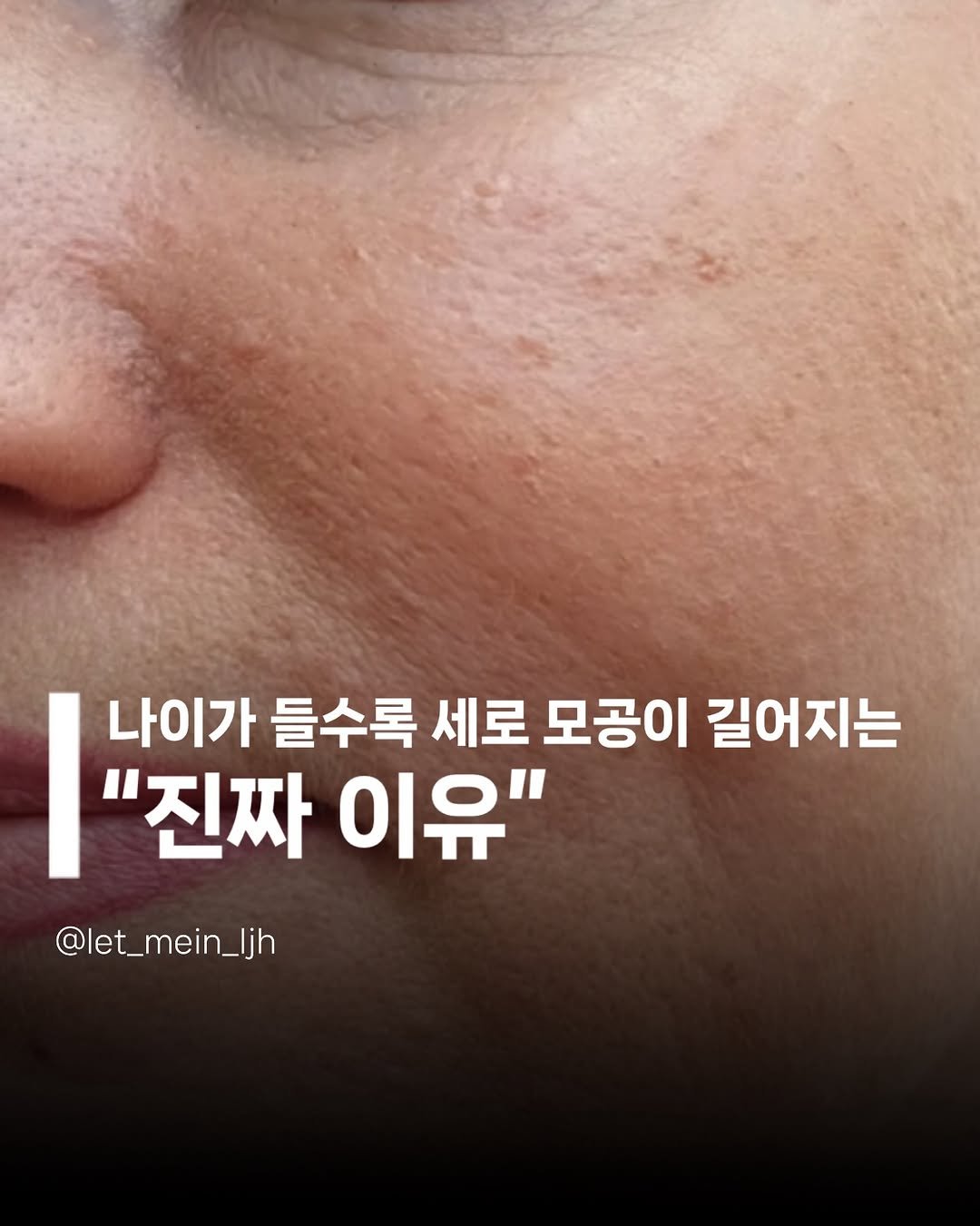 let_mein_ljh 게시물 이미지: 📌모공이 길어지는 “진짜 이유”

나이가 들수록
모공이 점점 길어지는걸...