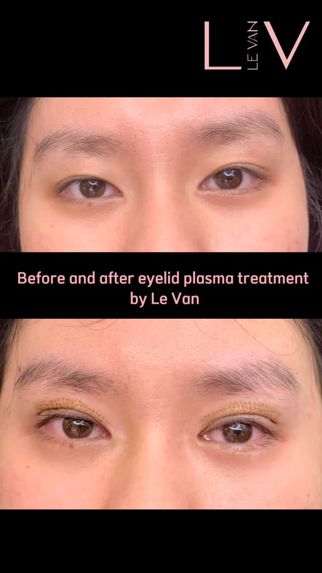 levan.nanoplasma 게시물 이미지: ✨ Plasma Eyelid Contouring ✨
Redefine your...