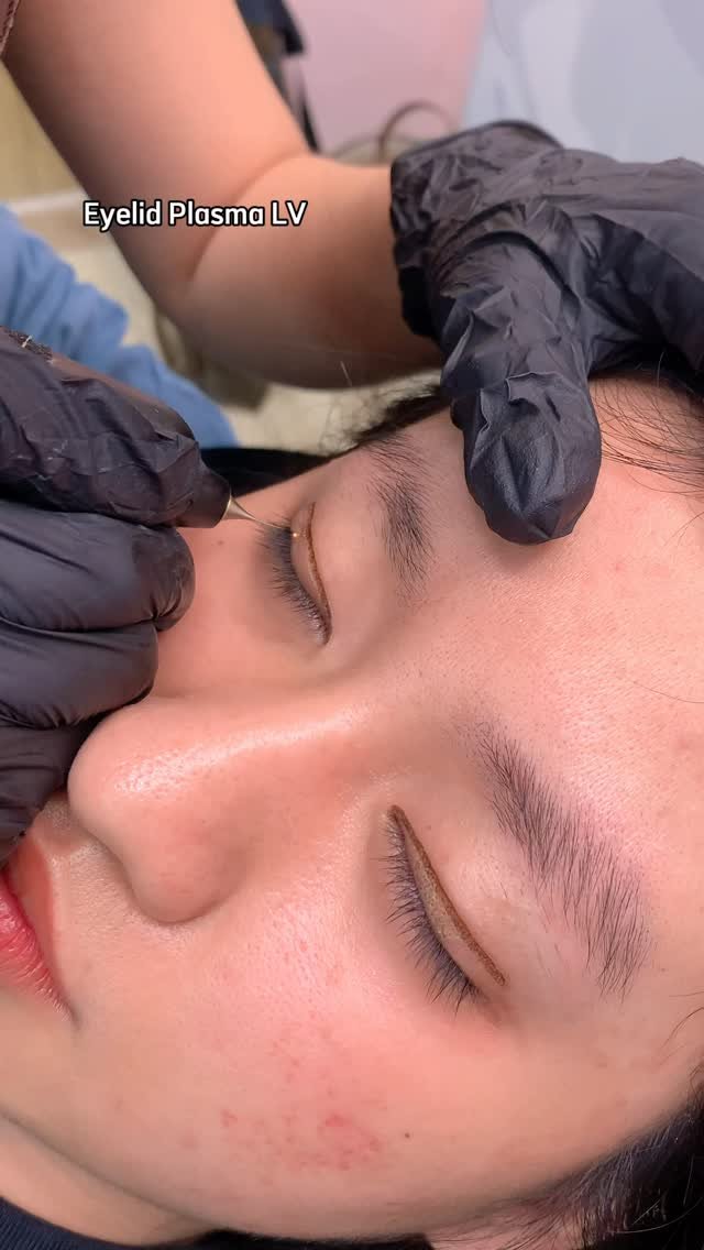 levan.nanoplasma 게시물 이미지: Non-surgical eyelid lift

Follow...