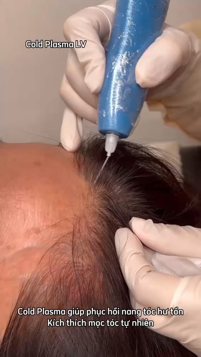 levan.nanoplasma 게시물 이미지: Advanced Cold Plasma Scalp TherapyBoost...