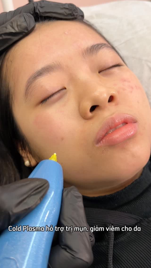 levan.nanoplasma 게시물 이미지: Plasma Acne Treatment ✨
Helps reduce acne,...