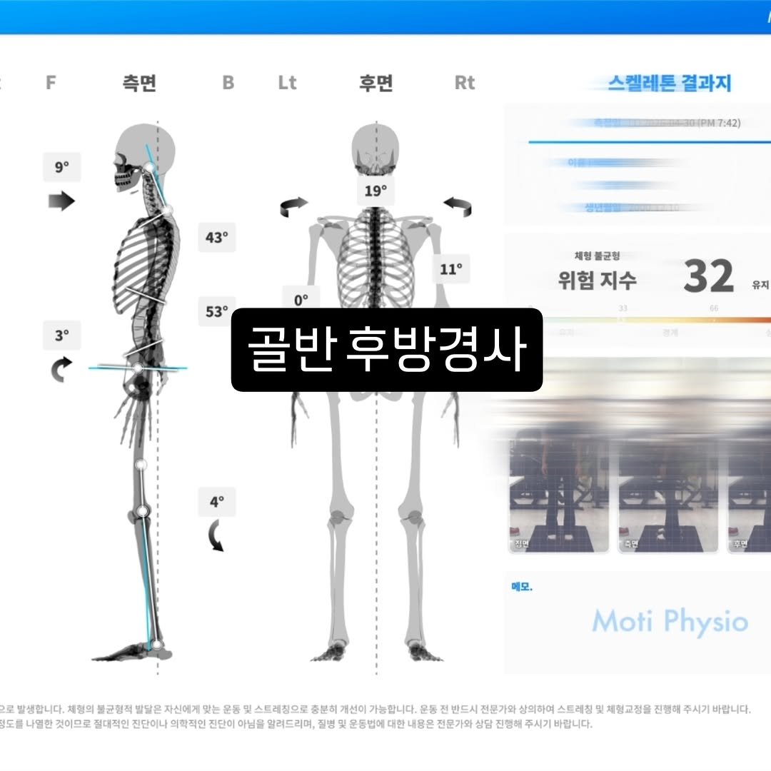 lifechange1_official 게시물 이미지: 정xx 회원님

라운드숄더, 거북목, 골반 후방경사 패턴으로 평소 어깨와 허리의...