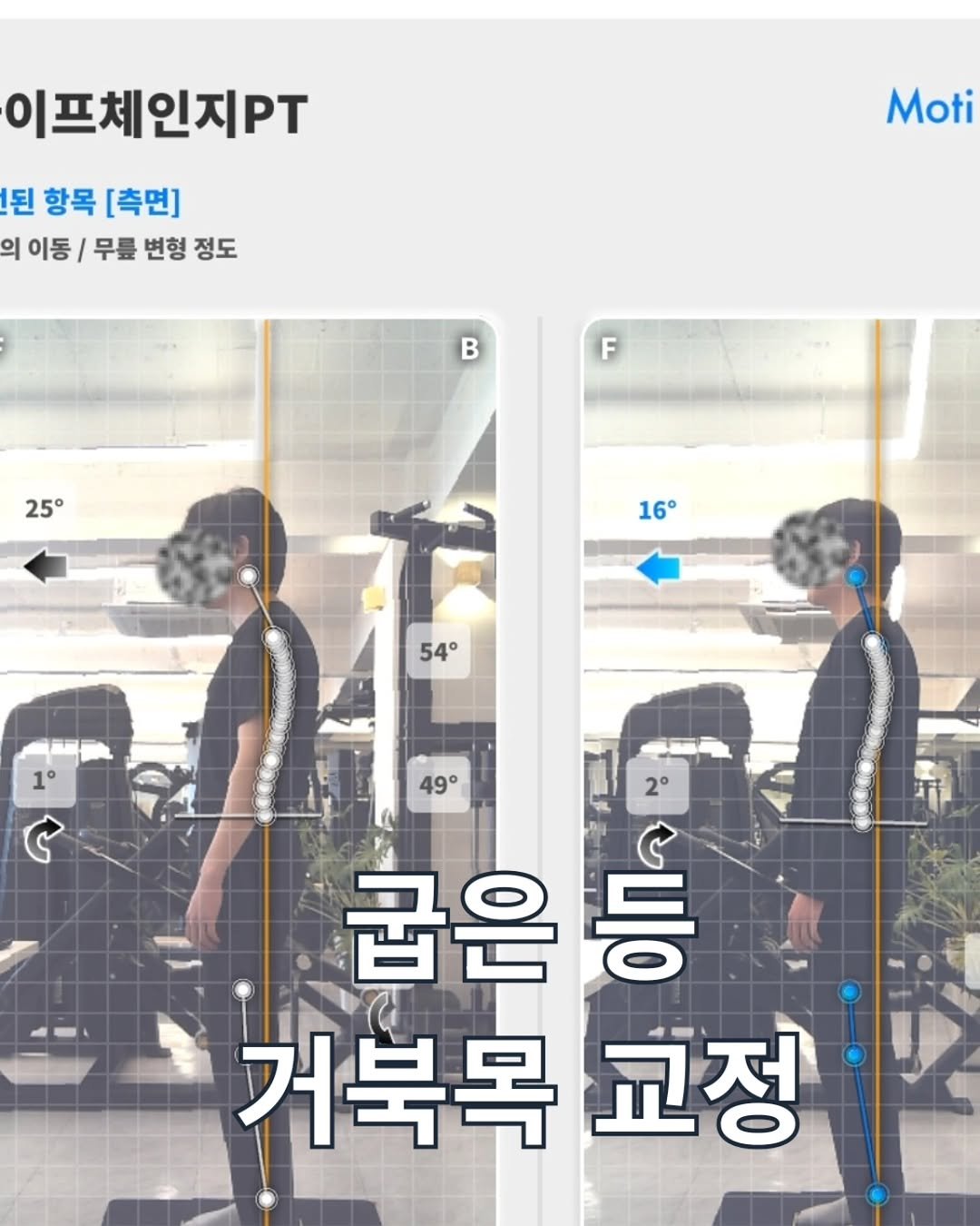 lifechange1_official 게시물 이미지: 골반 비대칭과 굽은 등으로 인해 신체의 전반적인 밸런스가 무너져 고민이셨던...