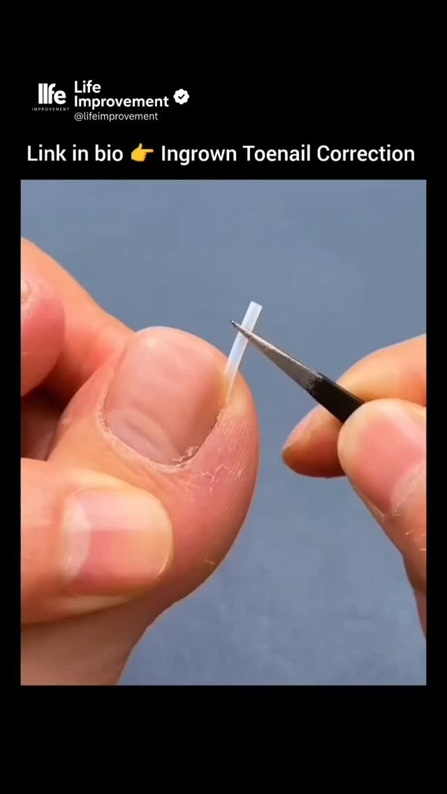 lifeimprovement 게시물 이미지: Link in bio 👉 Ingrown Toenail Correction 

Get...
