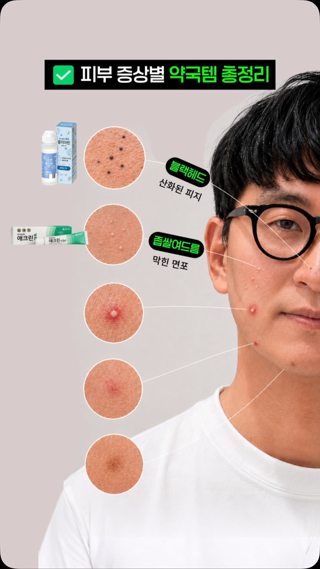 little_yaksa 게시물 이미지: 🚨 여드름 연고,
아직도 남들 사는 거 따라 사시나요?
피부 증상별 맞춤 약국 연고...