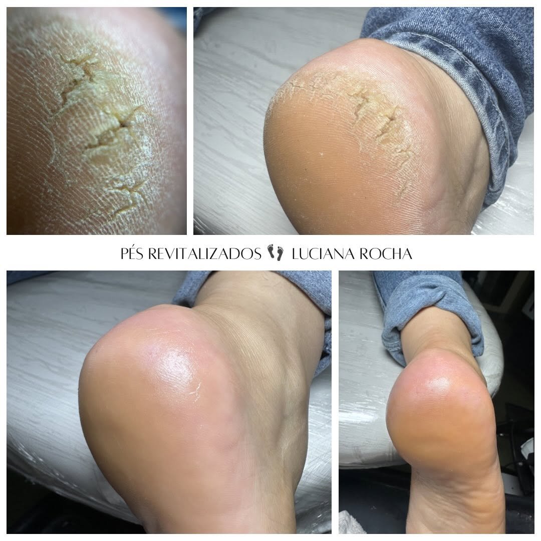 Photo by Luciana Rocha | Estética dos Pés / D’Epilação & Sobrancelhas in Studio Luciana Rocha. May be an image of ointment and text that says 'PÉS REVITALIZADOS REVITAI IUCIANA ROCHA'.