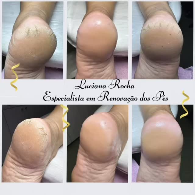 lucianagrocha 게시물 이미지: Resultados Reais ✨

#plasticadospes #pés...