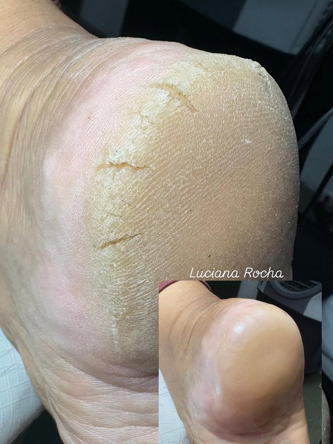 Photo by Luciana Rocha | Estética dos Pés / D’Epilação & Sobrancelhas in Studio Luciana Rocha. May be an image of one or more people, fingernails and text that says 'Luciana LucianaRocha Rocha'.