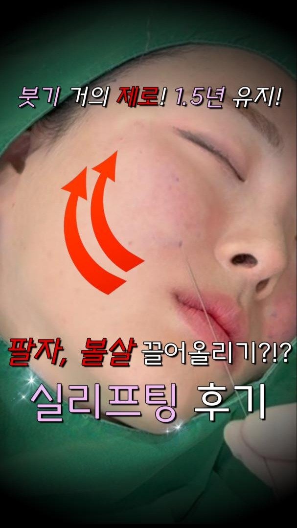 mademe_plastic_korea 게시물 이미지: 팔자, 볼살 뿌시고 온 실리프팅 후기!! #실리프팅

#메이드미 #메이드미성형외과...