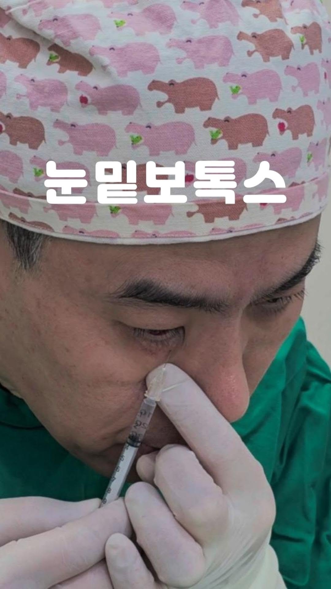 mademe_plastic_korea 게시물 이미지: 눈밑보톡스 체험시술 실제상황!! #보톡스

눈밑에 다크써클에 치료하기 위해 눈밑에...