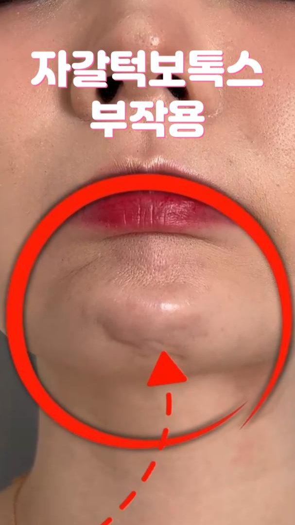 mademe_plastic_korea 게시물 이미지: 자갈턱보톡스 부작용 알사탕! #자갈턱보톡스

자갈턱보톡스 후에 드물게 나타나는 일명...