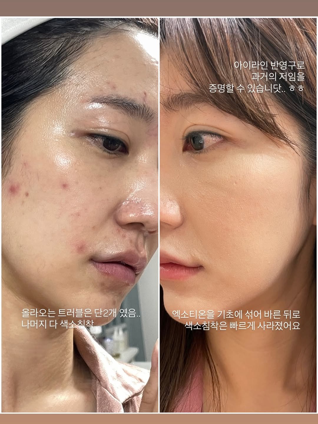 Photo shared by 매그니유/ GYURI 규리 on August 17, 2025 tagging @magniu_beauty. May be an image of 2 people and text that says '아이라인 반영구로 아이라인반영구로 반영 과거의 저임을 증명할수있습니닷.. 증명할 수 있습니닷.. ㅎㅎ ㅎ 올라오는 트러블은 단2개 였음.. 나머지 다 색소친착 엑소티온을 기초에 섞어 바른뒤로 뒤로 바른 색소침착은 빠르게 사라졌어요'.
