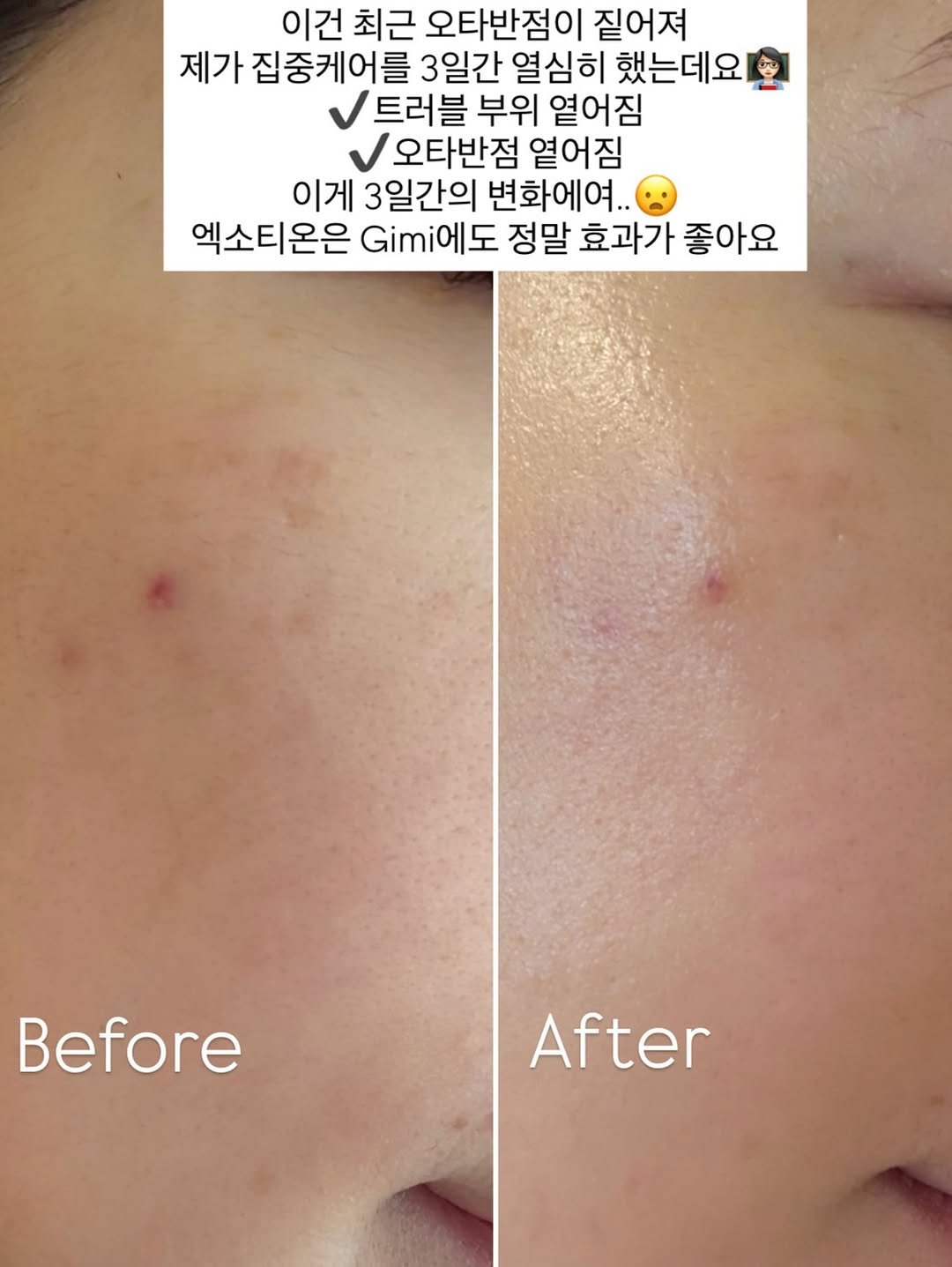 Photo shared by 매그니유/ GYURI 규리 on August 17, 2025 tagging @magniu_beauty. May be an image of 2 people and text that says '이건 최근 오타반점이 짙어져 제가 집중케어를 3일간 열심히 했는데요 트러블 부위 열어짐 오타반점 열어짐 이게 3일간의 변화에여.. 엑소티온은 Gm에도 정말 효과가 좋아요 Before After'.