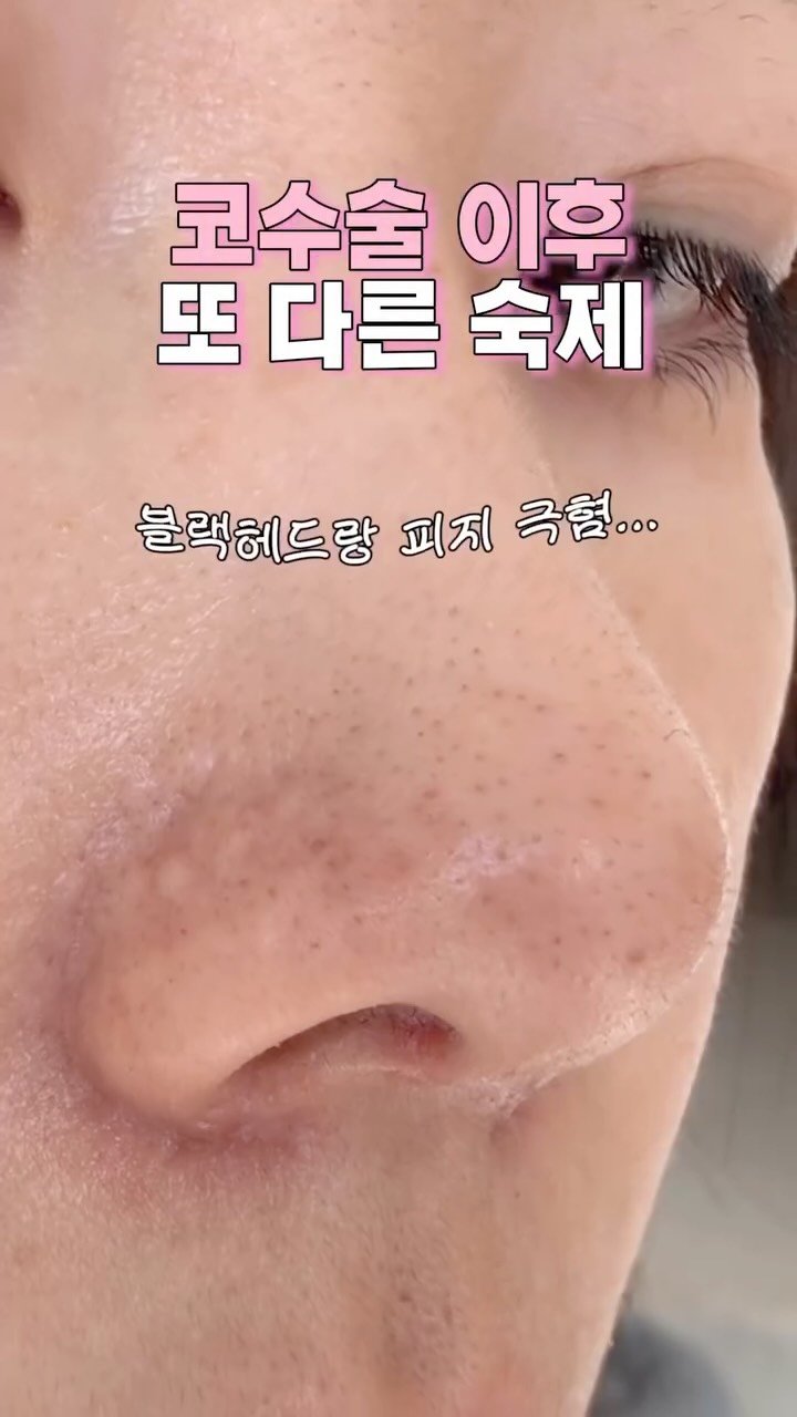 magniu_r 게시물 이미지: 피지엑스레이 보고 싶으신분!! 링크라고 댓글 남겨주시면 최저가 링크 드릴게요 💗💗💗...