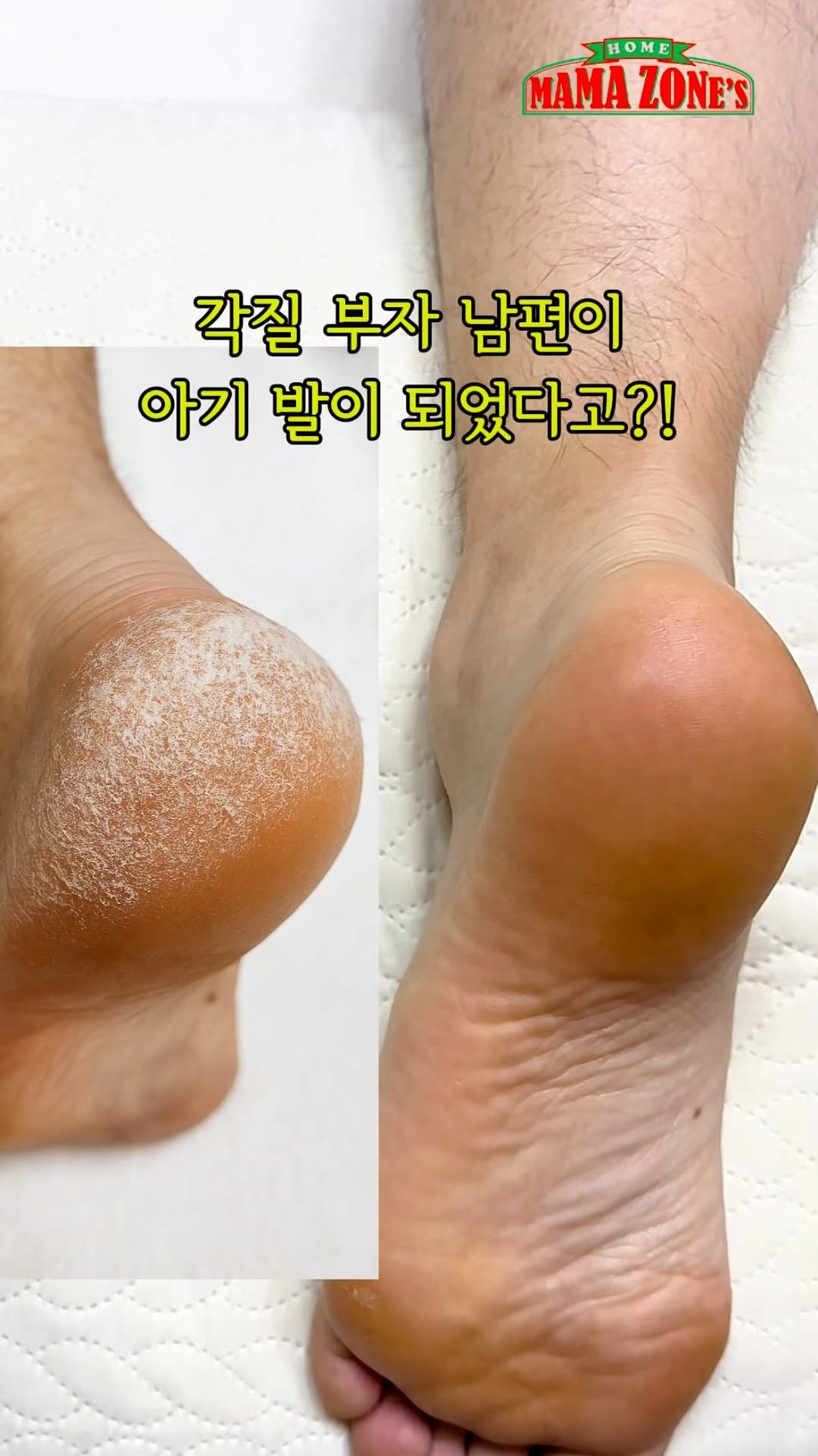 mama_zones 게시물 이미지: 👣아기 발바닥된 남편

👉🏻각질 부자 남편이 아기 발바닥처럼
엄청...