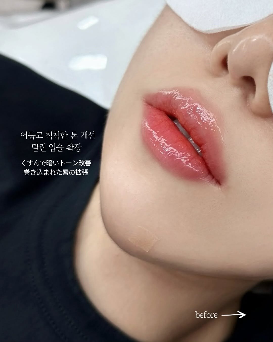 marchda_ 게시물 이미지: 위·아래 입술 테두리가 어둡거나
윗입술만 유독 어두운 경우,
어두운 부분만...