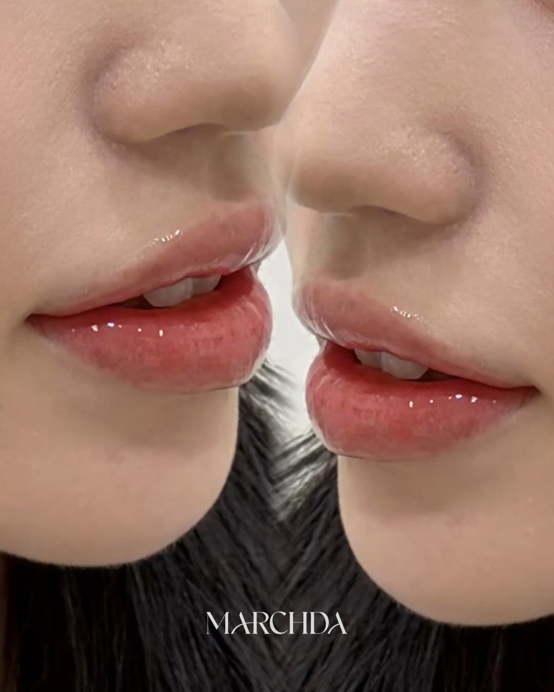 marchda_ 게시물 이미지: 시술 직후부터 자연스럽게.
시간이 지나도 어색하지 않게.
자연스러운 아름다움은...