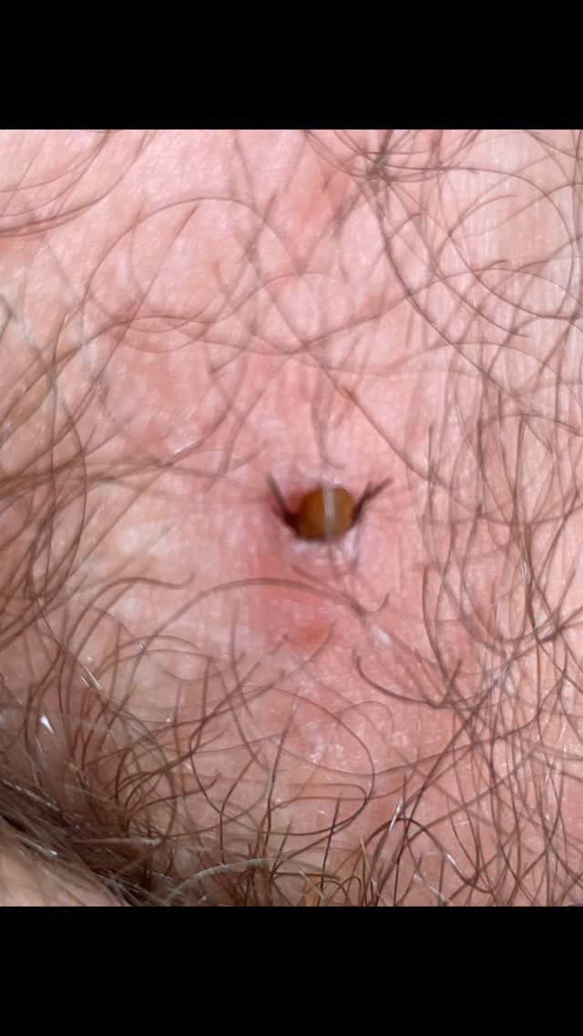 markxhogben 게시물 이미지: Tick where no tick has gone before