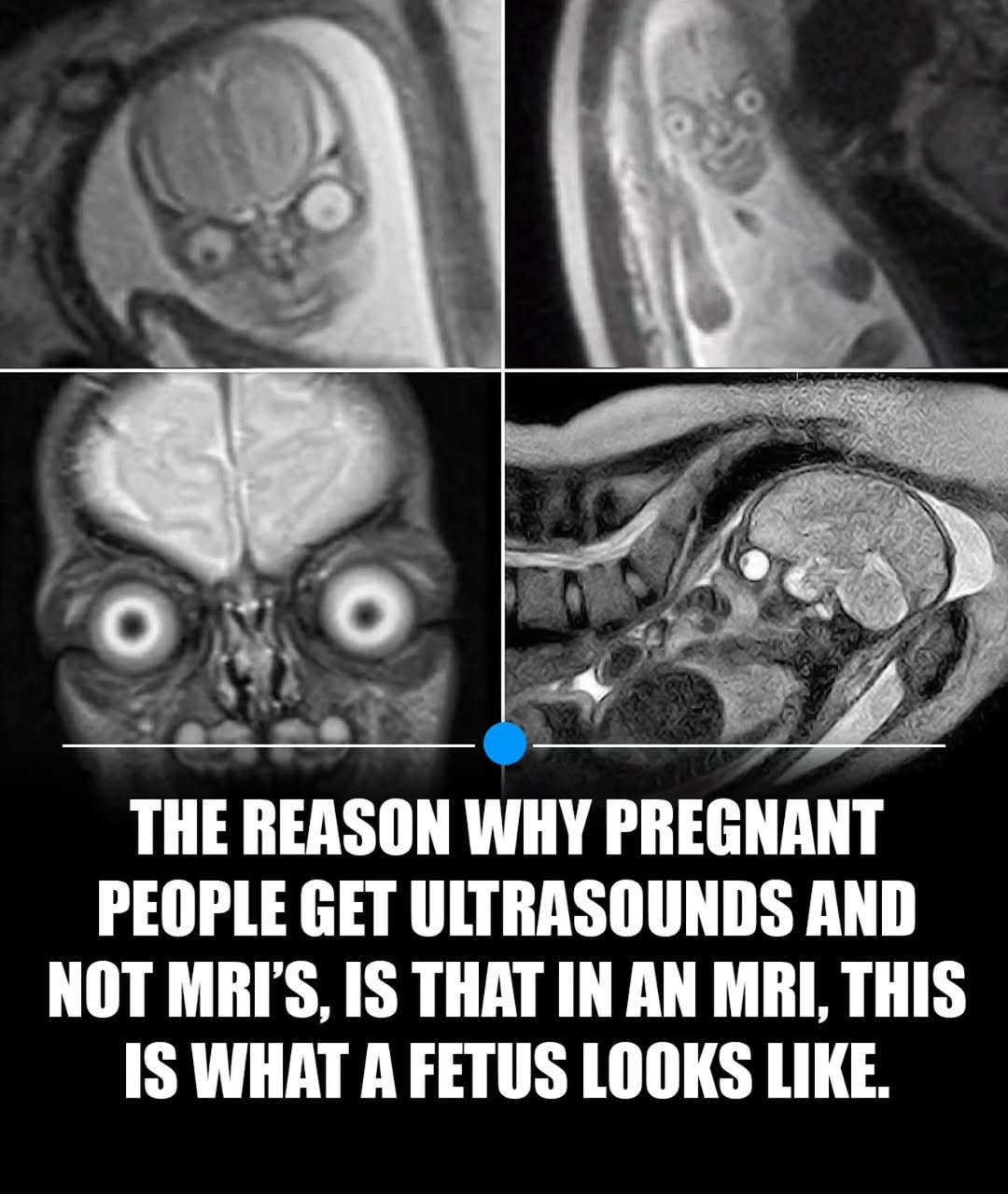 Photo by MTSBWY / Science, History, Entertainment & News on January 09, 2026. May be an image of xray and text that says 'THE REASON WHY PREGNANT PEOPLE GET ULTRASOUNDS AND NOT MRI'S, IS THAT IN AN MRI, THIS IS WHAT A FETUS LOOKS LIKE.'.