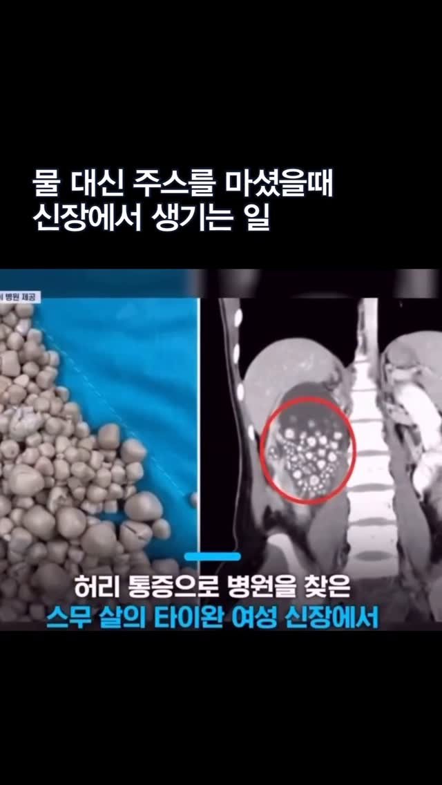meal.log__ 게시물 이미지: 스무 살 여성의 신장에서 무려 300개가 넘는 결석이 쏟아진 충격적인 뉴스,...