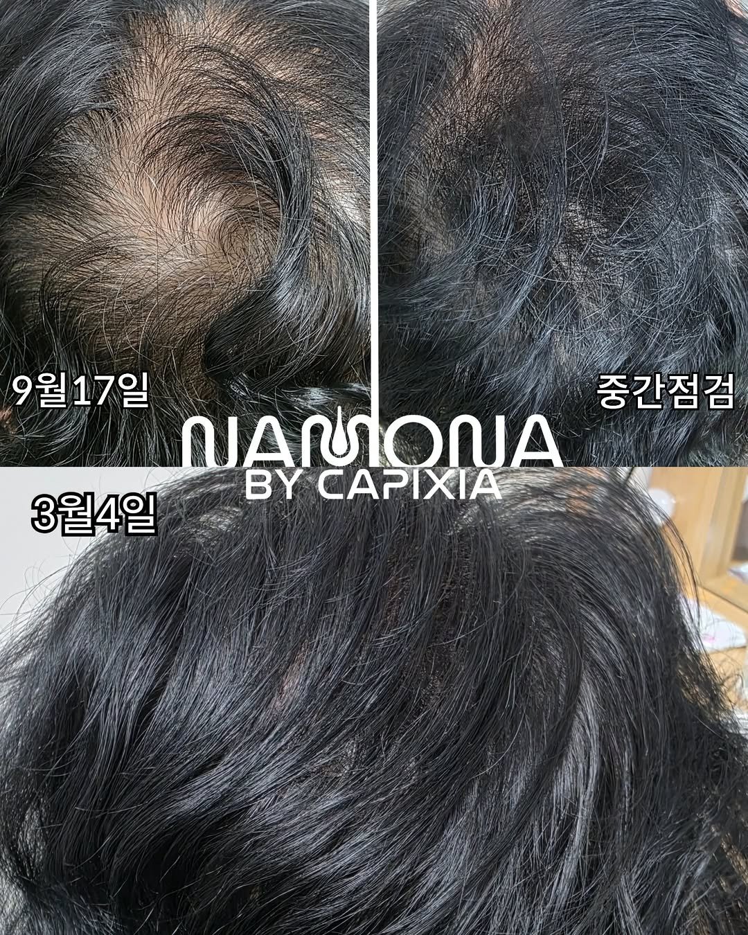 meebbeunada 게시물 이미지: 김해 탈모관리 성지 🧞‍♂️💜

위 고객님은 9월17일 - 3월4일 
대략5개월...
