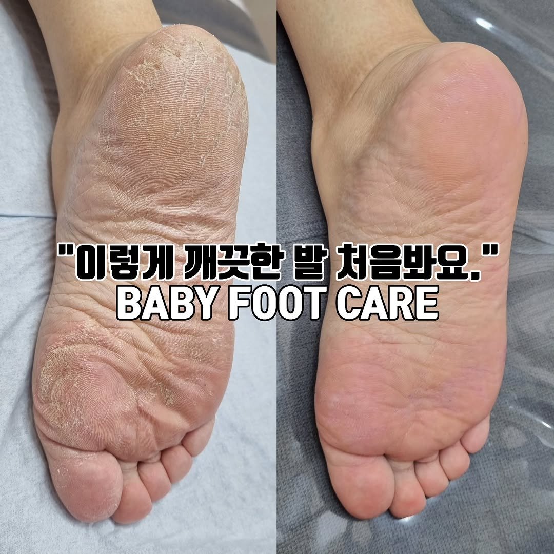 meebbeunada 게시물 이미지: 찾아오는 풋케어 성지🦶🤍

오랜 고객님들은 아시다시피
전 처음에 풋케어 외길만...