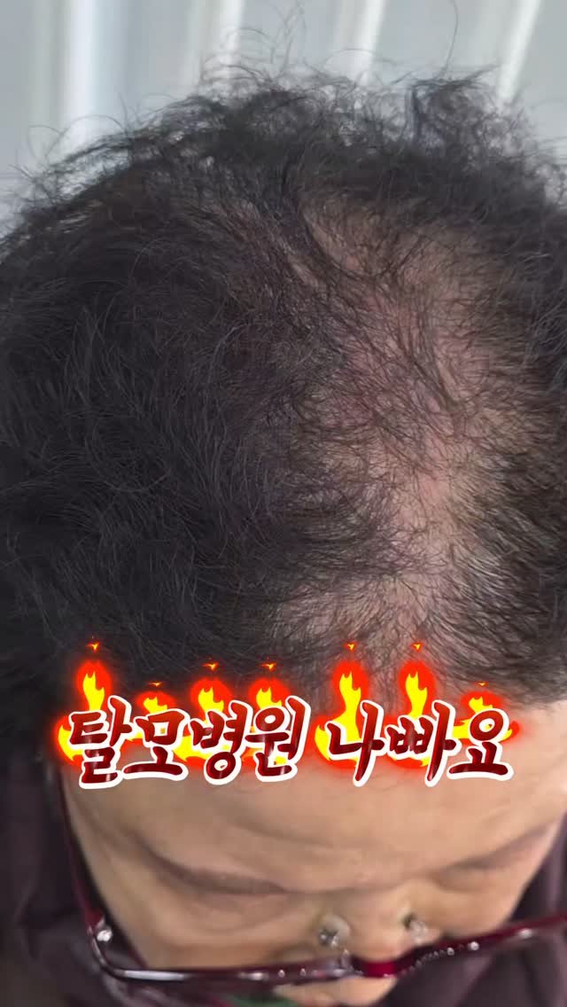 meebbeunada 게시물 이미지: 80대 여성 탈모고객님 이야기

나이가 많다고
머리 빠지는게 신경쓰이지 않는건...