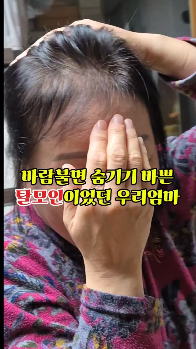 meebbeunada 게시물 이미지: 빠져대는 머리카락 붙잡는 방법 😲

저도 처음에 믿지않았던
작은 앰플의 힘은...