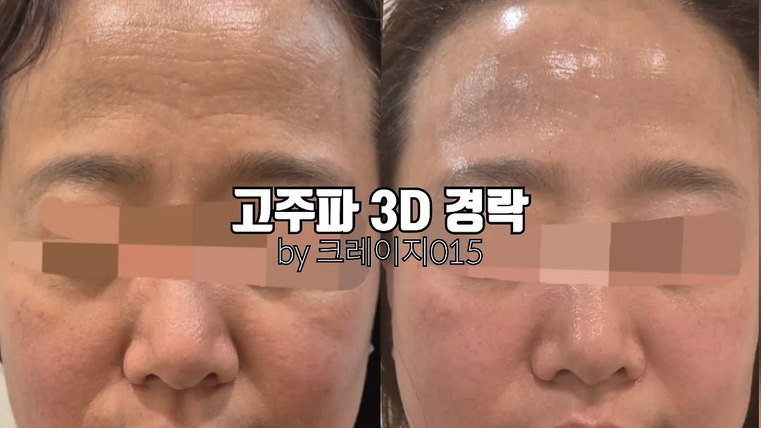 meebbeunada 게시물 이미지: 고주파로 경락관리를 받는다면?

크레이지015은 
샷만 띠딕 쏘는 고주파가...