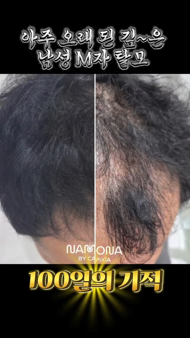 meebbeunada 게시물 이미지: 아주 깊고 오래된 남성M자탈모

완전 깊게 오래된 M자탈모입니다,
아직 이마라인은...