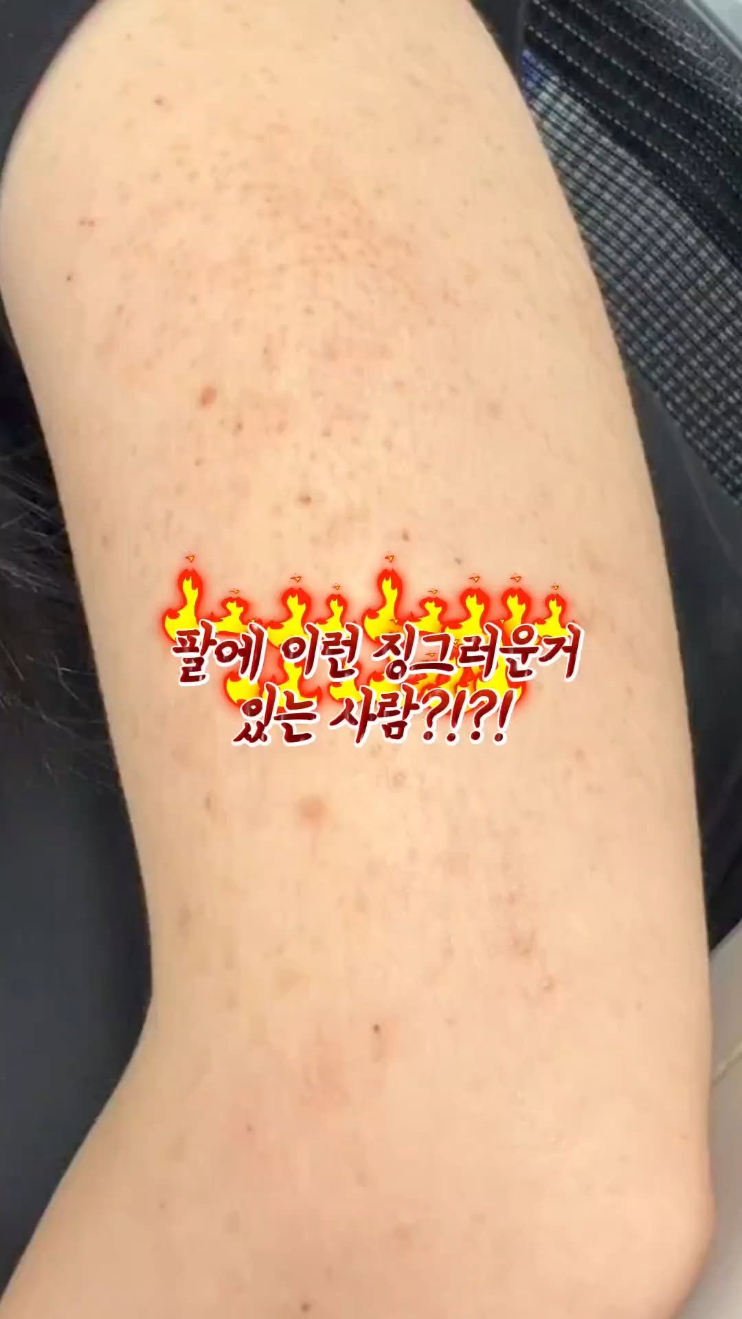 merrylevy_c 게시물 이미지: 팔에 오돌토돌 까만 점들 때문에
스트레스 받으셨던 분들 계신가요?🥲

이거 인그로운...