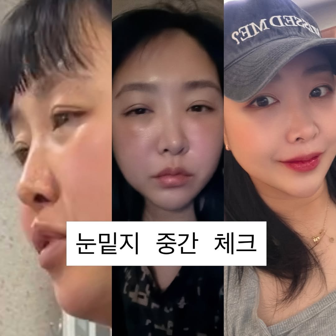 mimoade_ 게시물 이미지: 와 부기가 너무 심해가지고 진짜 그거 어떻게 해야 되나 했는데 약국 약도 필요 없고...