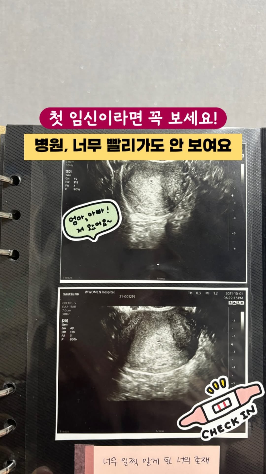 mind.mom__ 게시물 이미지: 첫째때 임테기 두 줄 뜨자마자 병원에 갔다가
“아직 모르겠네요. 자궁외 임신일 수도...