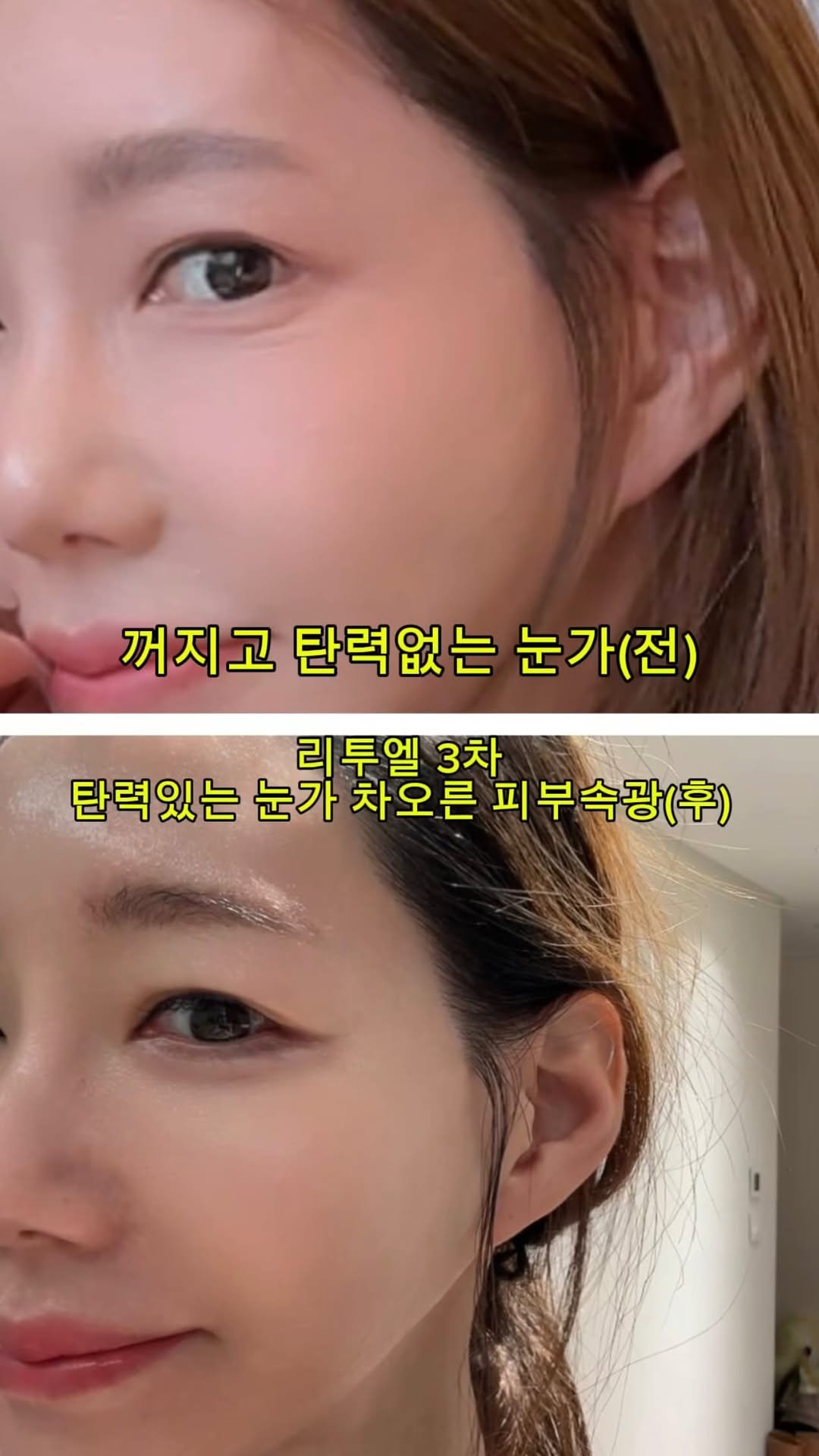 minimiel_46 게시물 이미지: 🔆선택 이유 & 시술 경험

요즘 헐리우드에서
항노화·회춘 시술로 불리며 화제가...