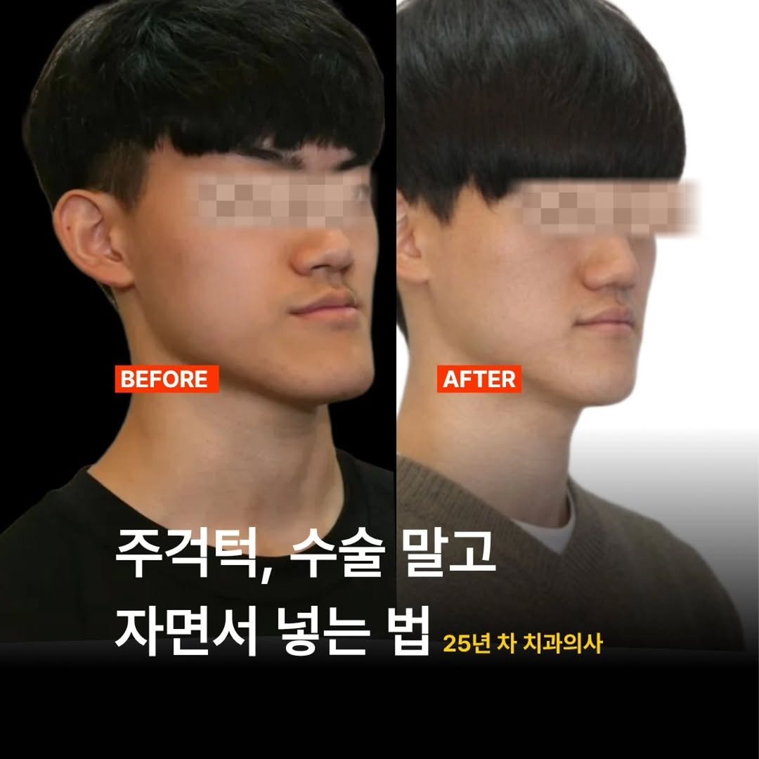 miso5652812 게시물 이미지: 주걱턱 자르기 전에
확인해 볼 것이 있습니다.

뼈 절단 없이
턱 위치를 바로잡는 ...
