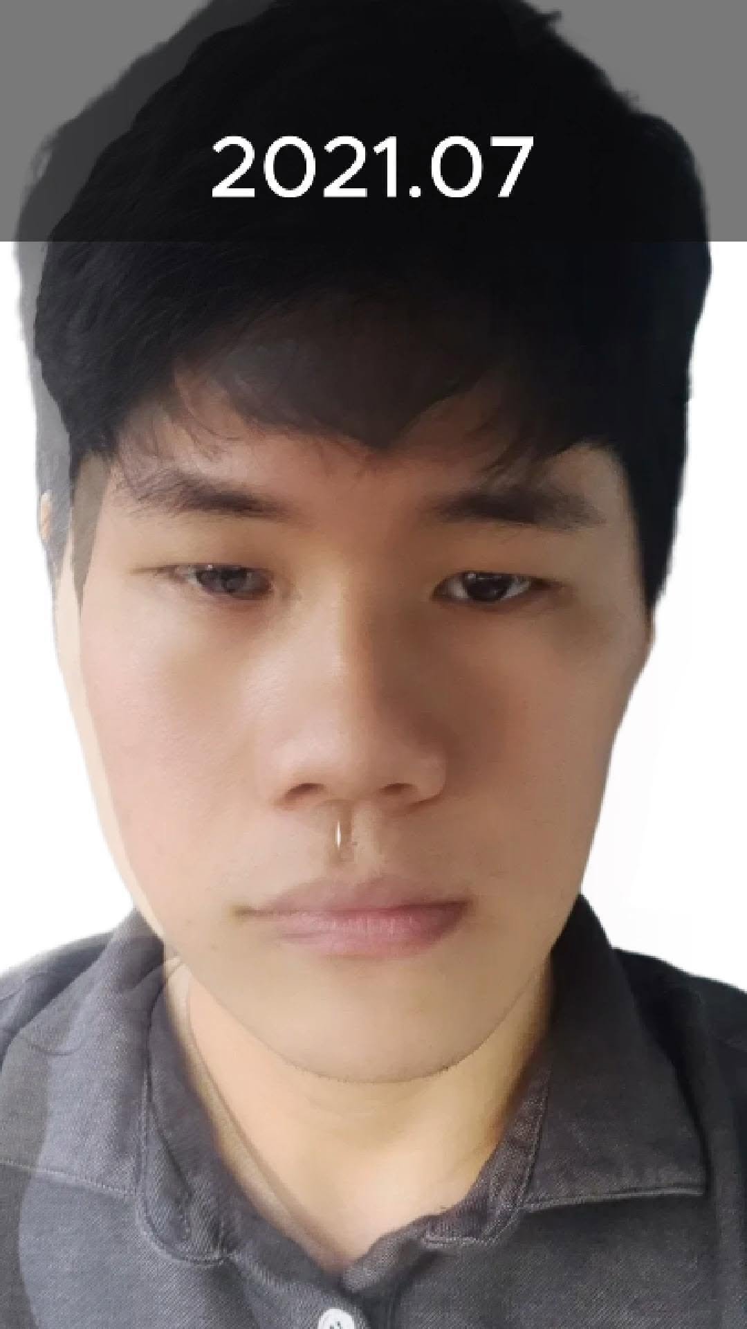 miso5652812 게시물 이미지: 안면비대칭, 주걱턱 뼈문제가 조금만 있으면 너무 쉽게 양악을 권유합니다.

혹시...