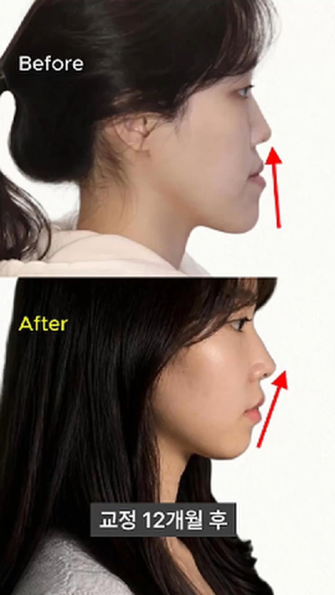 miso5652812 게시물 이미지: 안면비대칭, 주걱턱 뼈문제가 조금만 있으면 너무 쉽게 양악을 권유합니다.

혹시...
