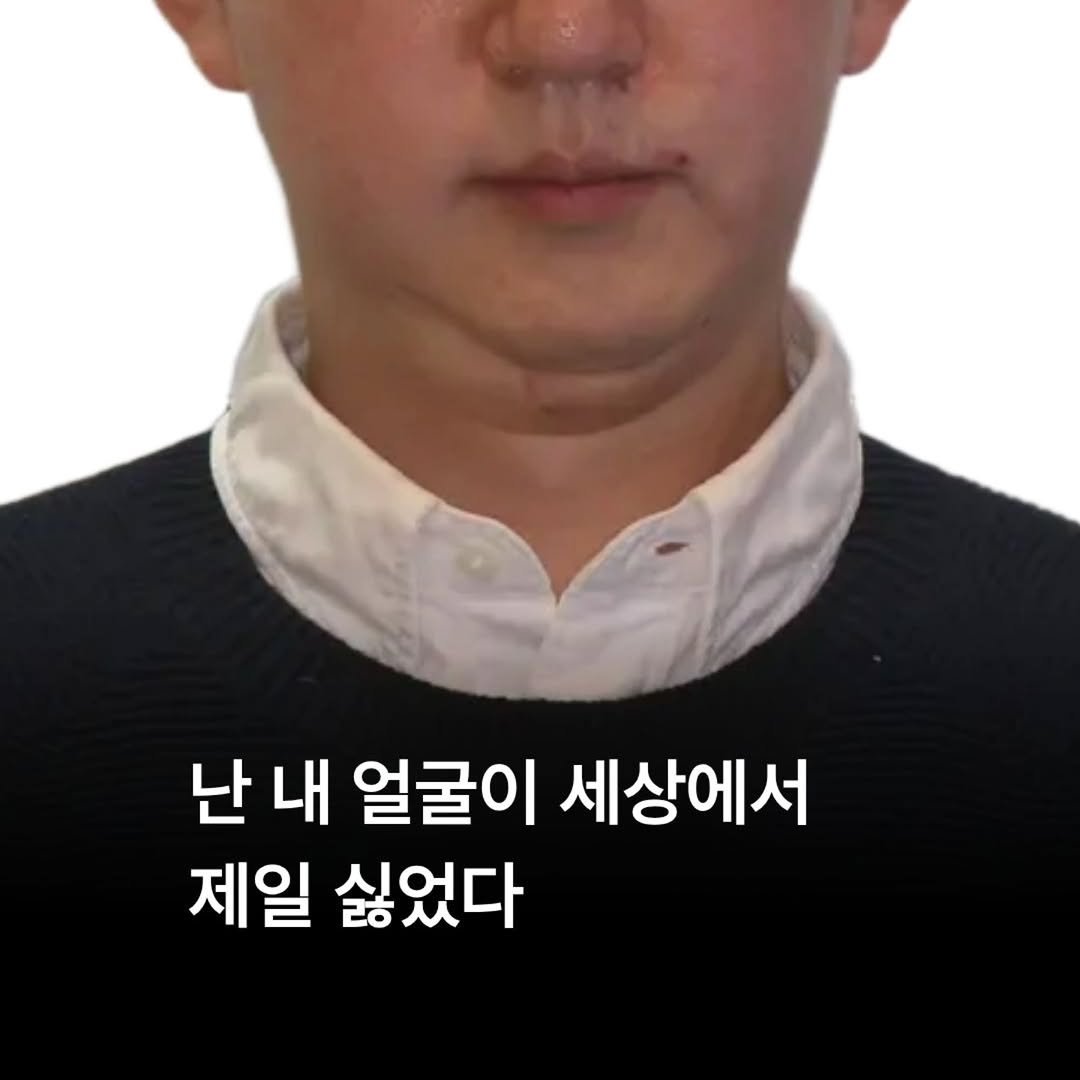 miso5652812 게시물 이미지: "양악 수술밖에 답이 없다"는 말에
눈앞이 캄캄했어요.

수술은 무섭고, 비용도...