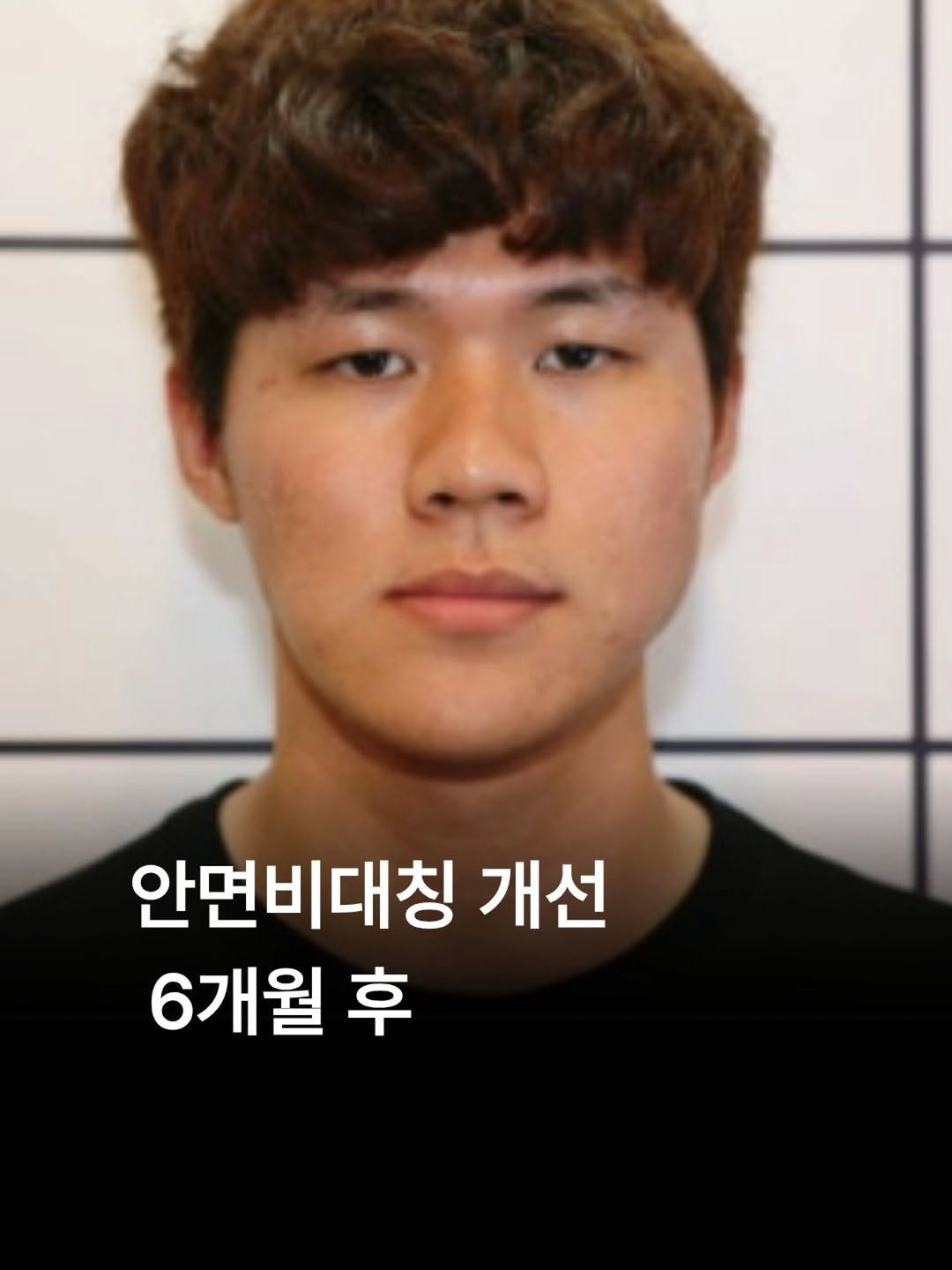 miso5652812 게시물 이미지: 교정의 중요성. 
교정 할때 양악 대신 이걸 했더니 이렇게 바뀌네,..

저는...