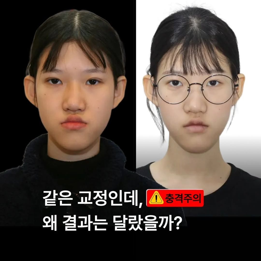 miso5652812 게시물 이미지: 같은 교정인데, 결과가 다른 이유
👉 출발점이 달랐기 때문입니다.

많은...