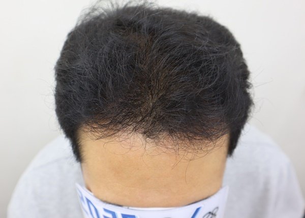 Photo by 모힐 모발이식 비절개모발이식 헤어라인교정 on August 27, 2025. May be an image of 1 person, hair and text.