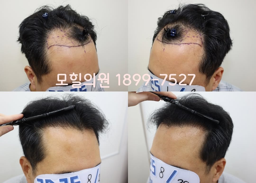 Photo by 모힐 모발이식 비절개모발이식 헤어라인교정 on August 27, 2025. May be an image of 4 people, hair and text.