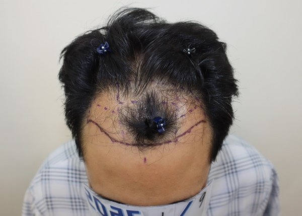 Photo by 모힐 모발이식 비절개모발이식 헤어라인교정 on August 27, 2025. May be an image of 1 person and text.