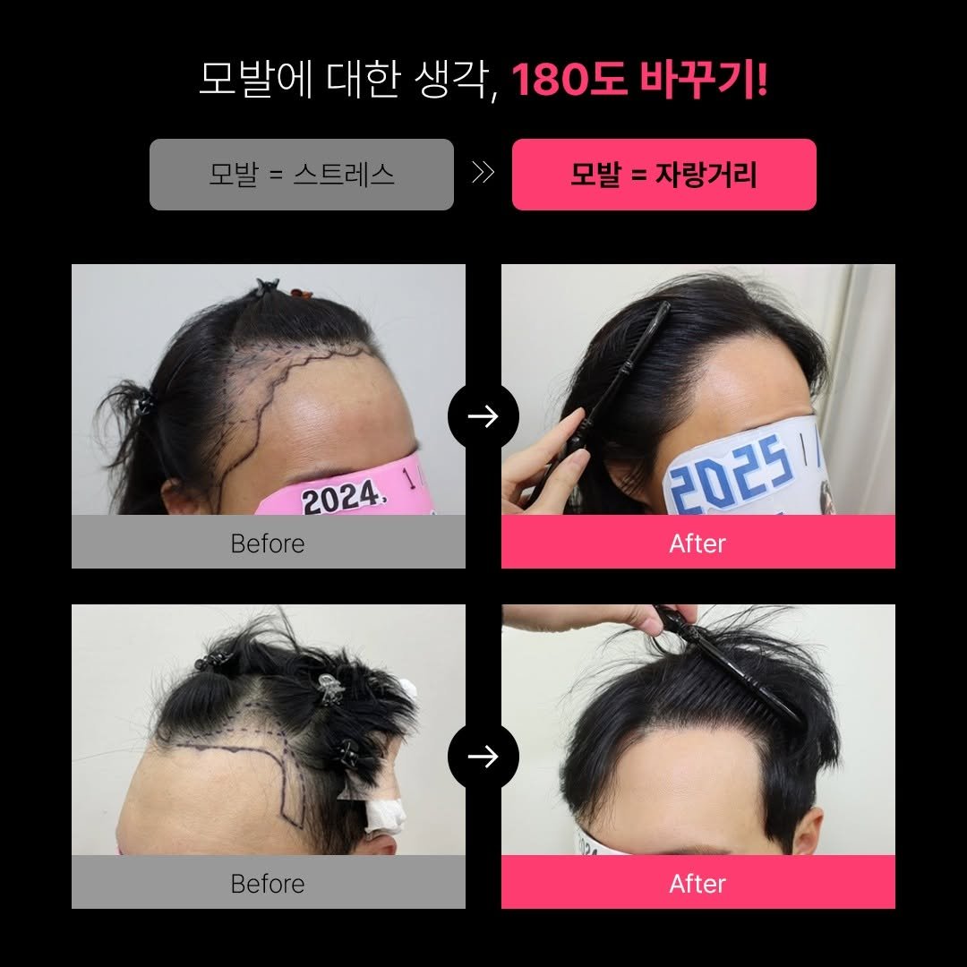 Photo by 모힐 모발이식 비절개모발이식 헤어라인교정 on July 04, 2025. May be an image of one or more people, hair and text that says '모발에 대한 생각, 180도 바꾸기! 모발= 모발 스트레스 모발 = 자랑거리 2024. Before 2025/ After After Before After'.