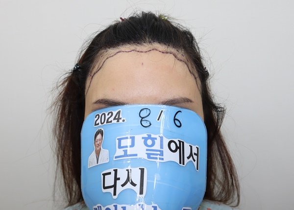 Photo by 모힐 모발이식 비절개모발이식 헤어라인교정 on August 24, 2025. May be an image of 1 person, hair and text that says '2024. 816 모획에서 다시 لن'.