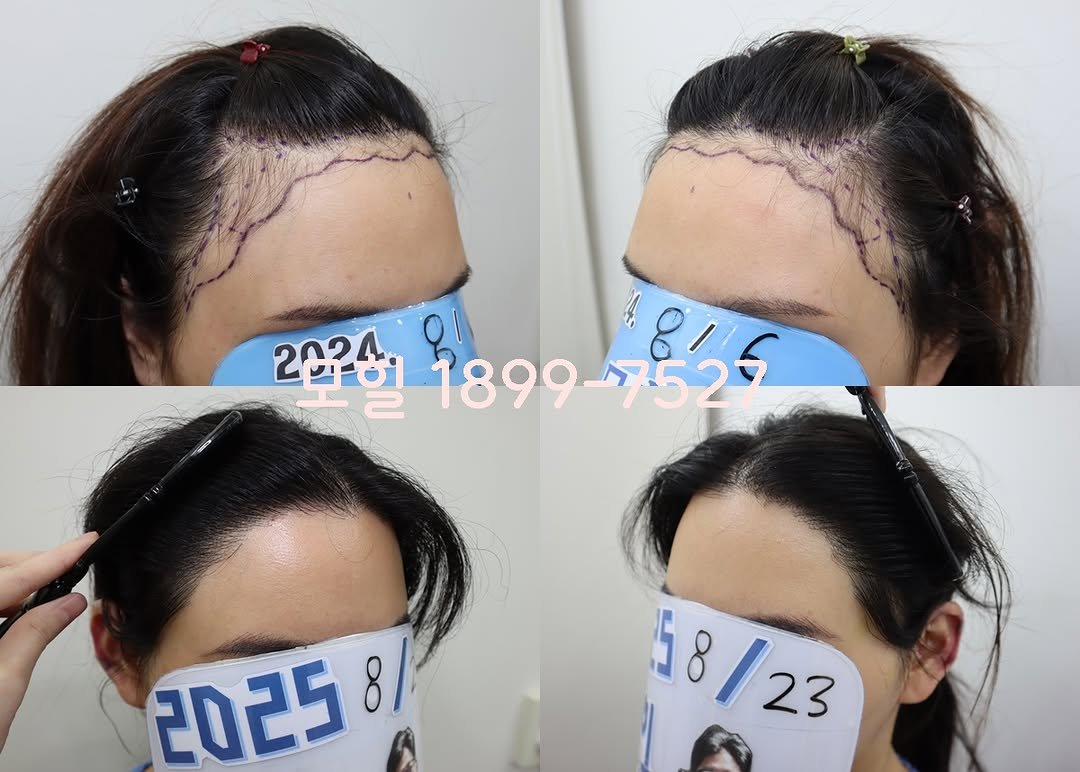 Photo by 모힐 모발이식 비절개모발이식 헤어라인교정 on August 24, 2025. May be an image of 4 people, hair and text.