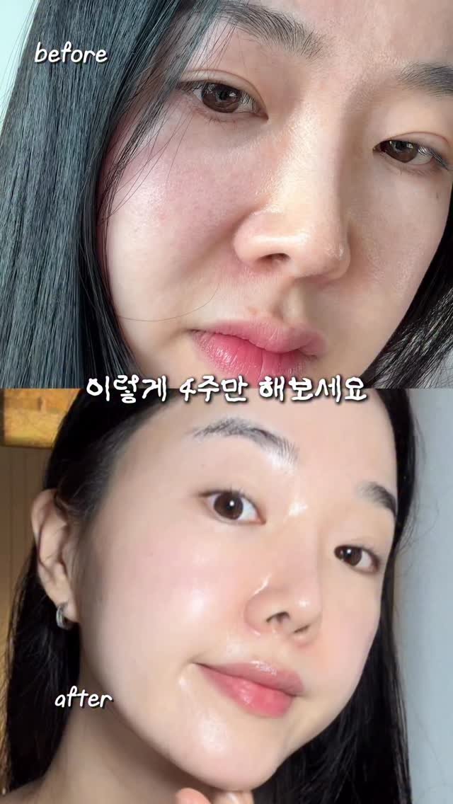 mollyunniee 게시물 이미지: 4주만에 팔자주름이 이만큼이나 옅어졌다고?!

다이어트하면서 얼굴살 훅...