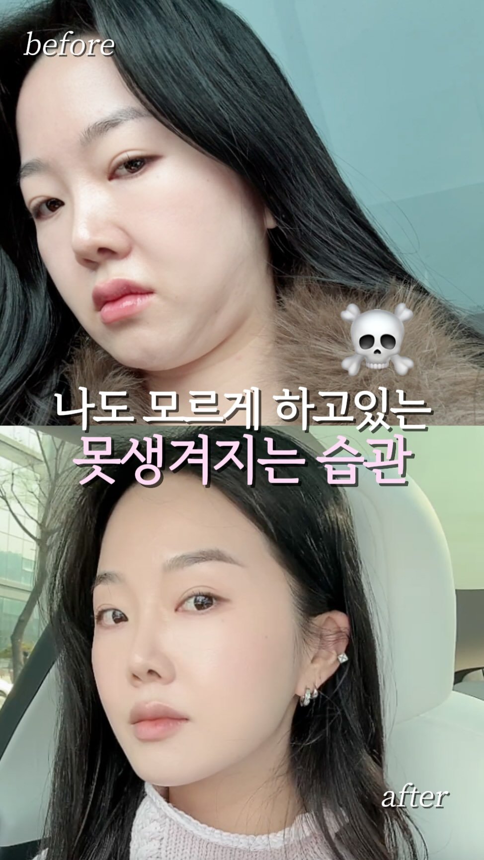 mollyunniee 게시물 이미지: 작은 습관들이 쌓이고 쌓여서
내 얼굴라인 다 망가진다?

제가 다니는 피부샵...